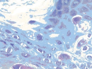 Abb 4: PAS-positive Paget-Zellen.