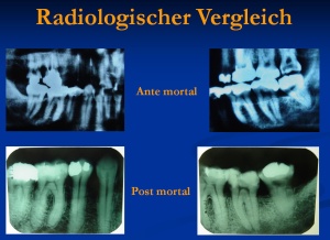 Abb. 1: Vergleich der ante- und post-mortalen zahnärztlichen Röntgenbilder