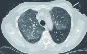 Fallbeispiele zu Differenzialdiagnosen atypischer Pneumonien in der COVID-19-Pandemielage