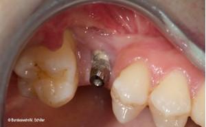 Kieferorthopädische Zahnbewegung führt zum Knochenverlust am Implantat
